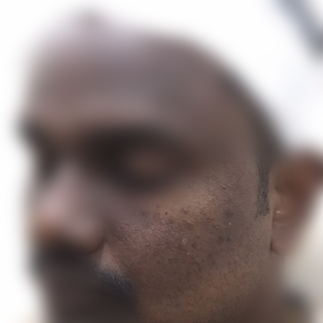 Acne & acne scars before treatment