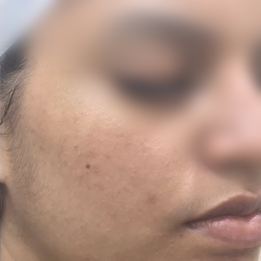 Acne & pigmentation after treatment