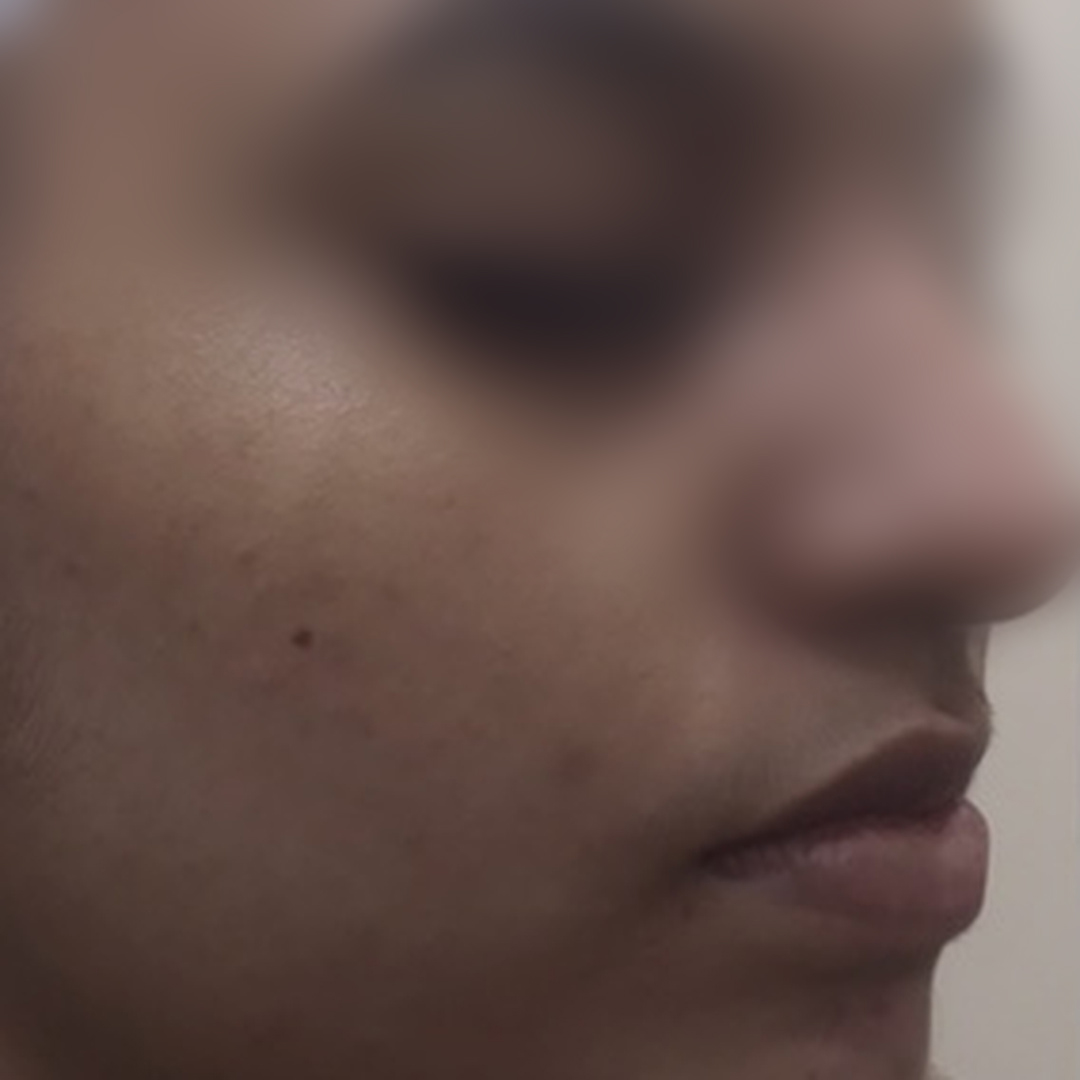 Acne & pigmentation before treatment