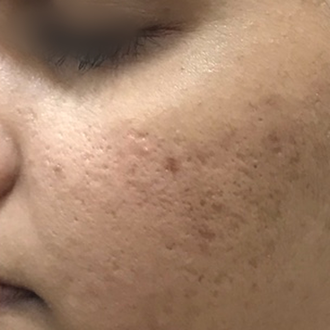 Acne scars & pigmentation after treatment