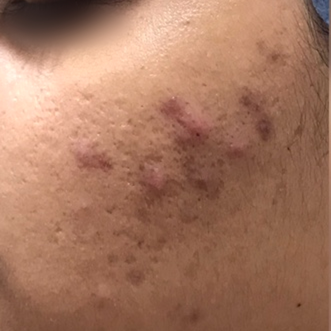 Acne scars & pigmentation before treatment