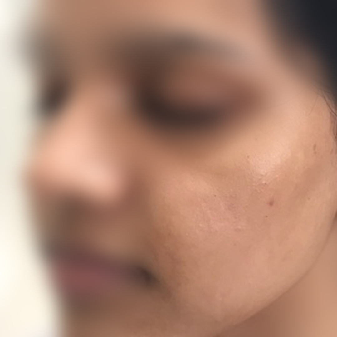 Acne after treatment