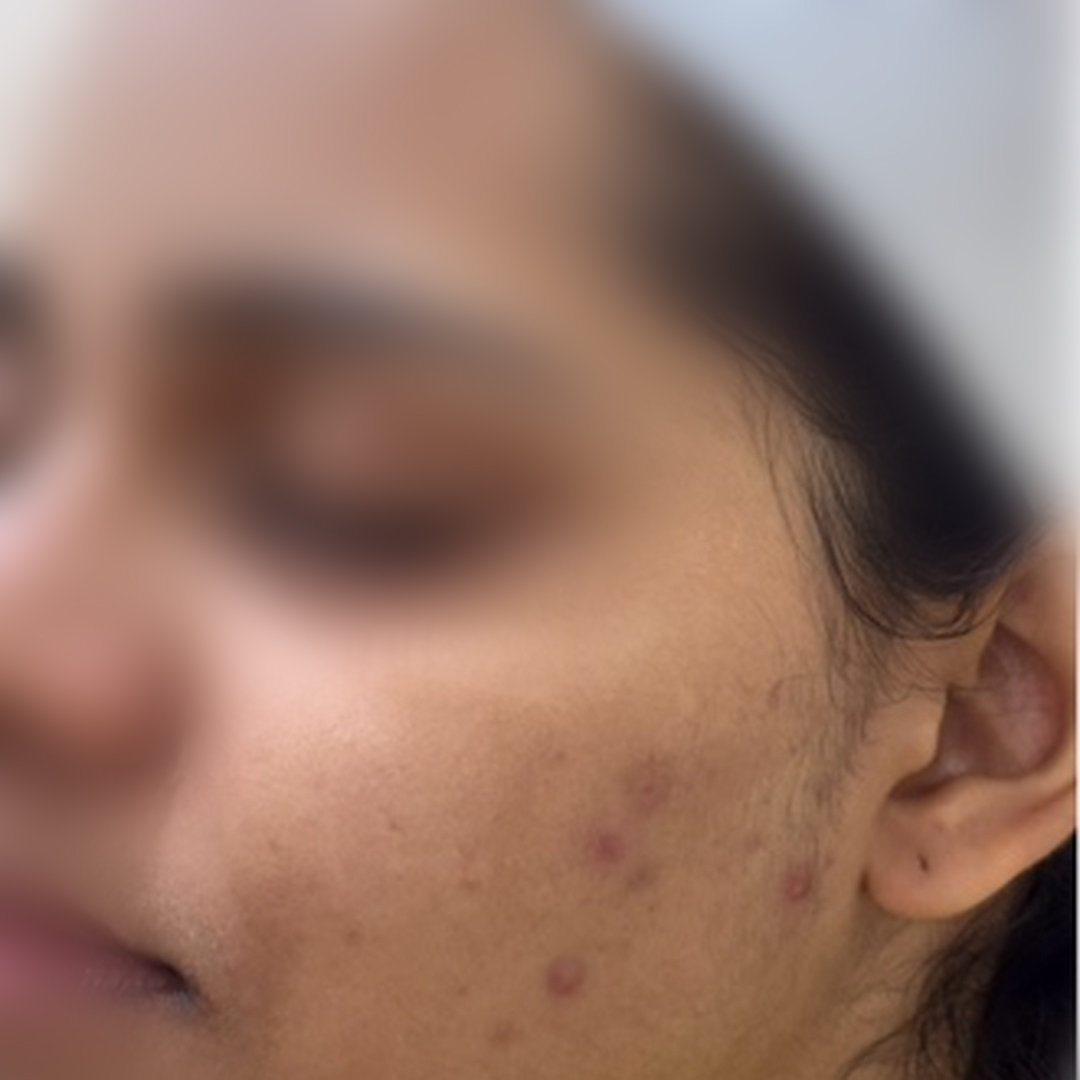 Acne before treatment