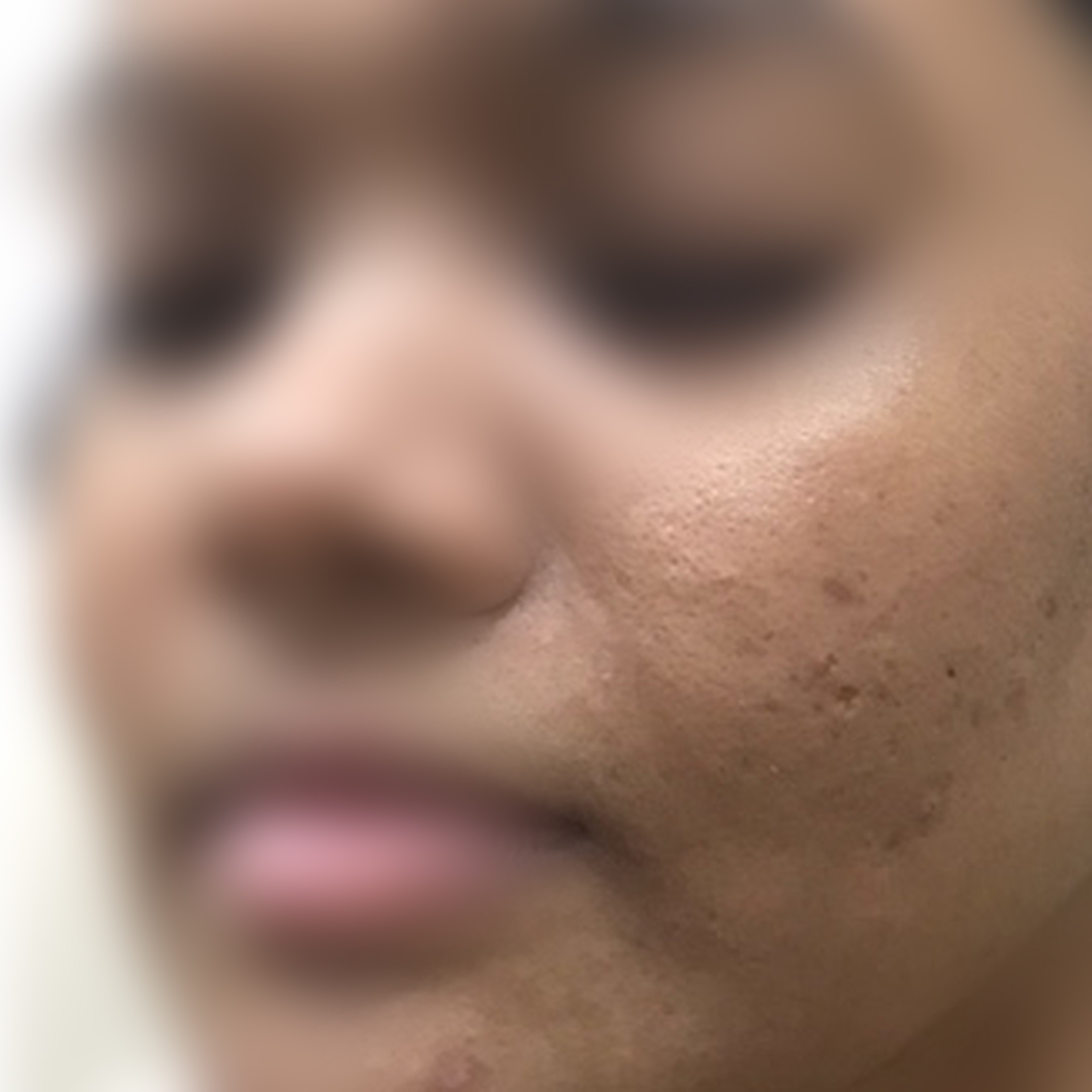 Acne scars after treatment