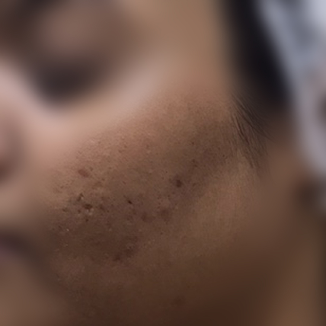 Acne scars before treatment