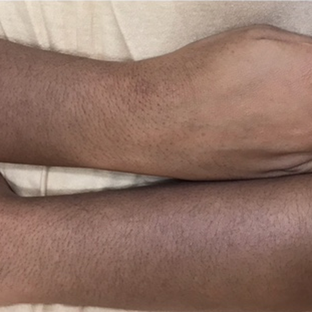 Arm pigmentation before treatment