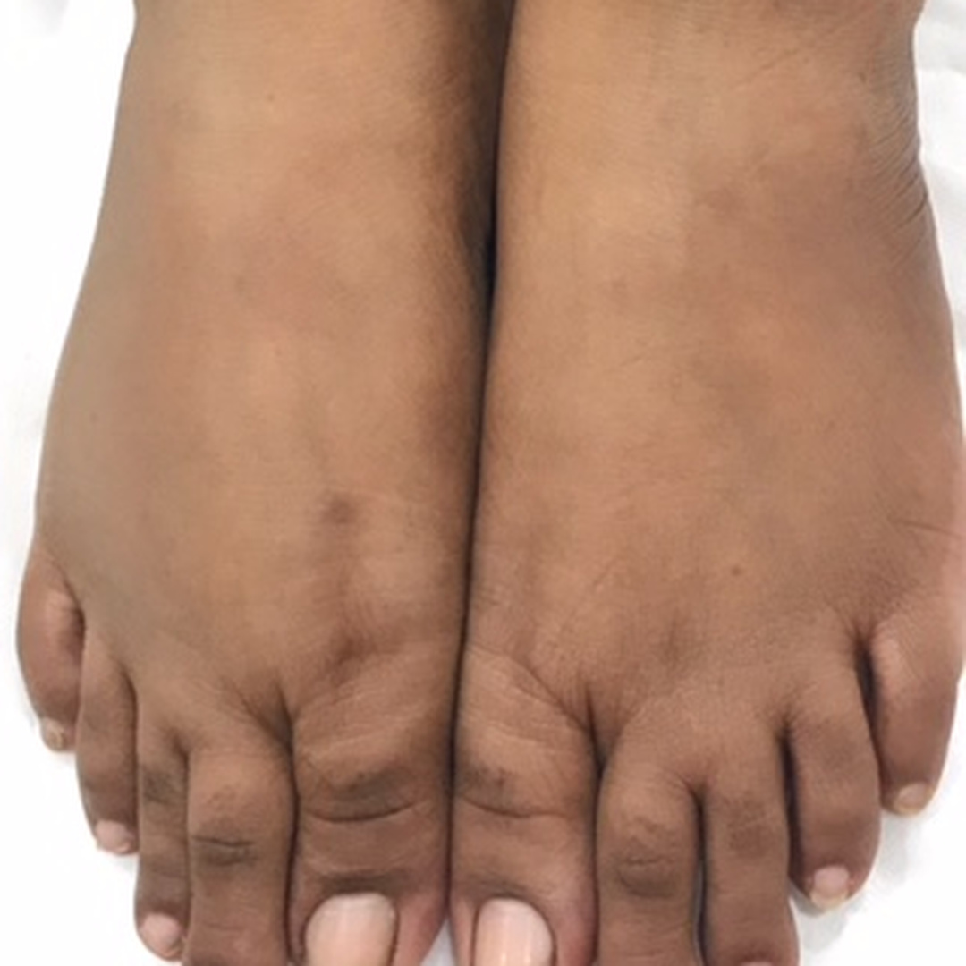 Feet pigmentation after treatment