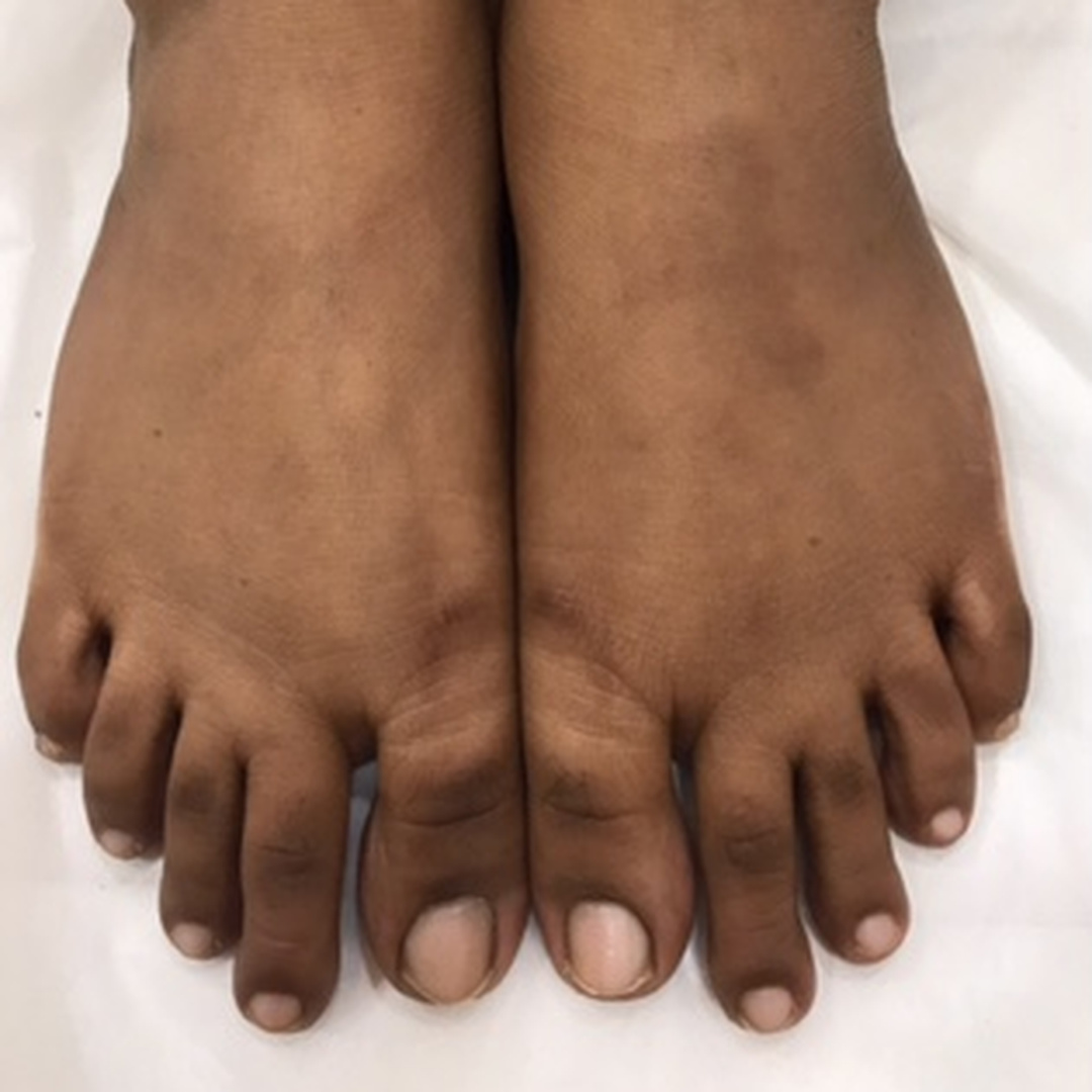 Feet pigmentation before treatment