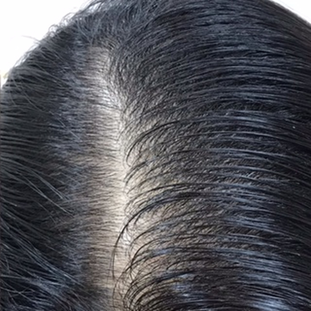 Hair thinning after treatment