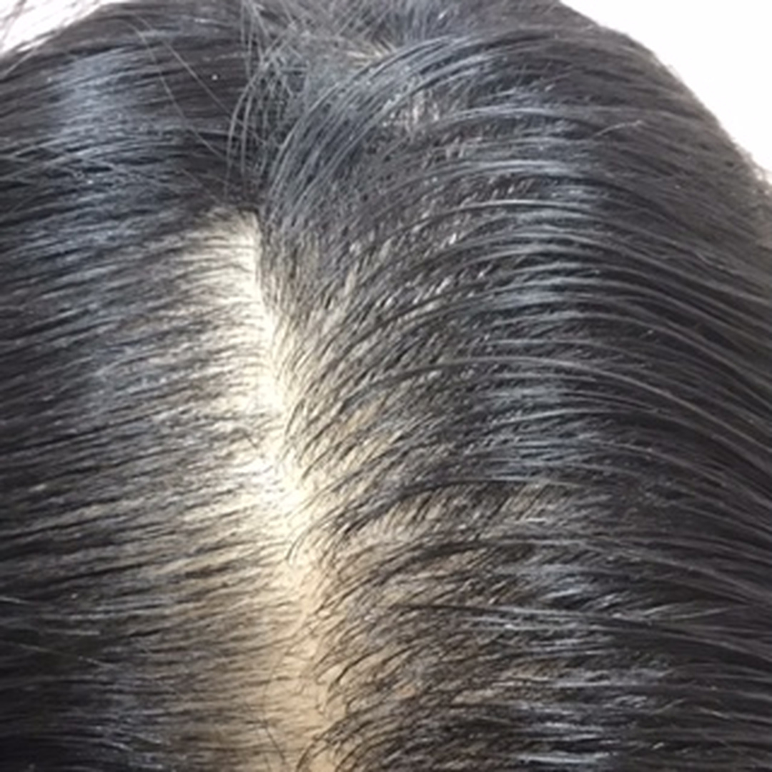 Hair thinning before treatment