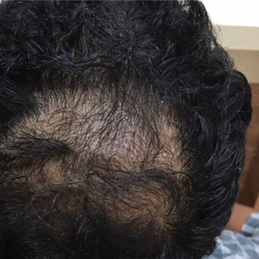 Crown hair thinning after treatment