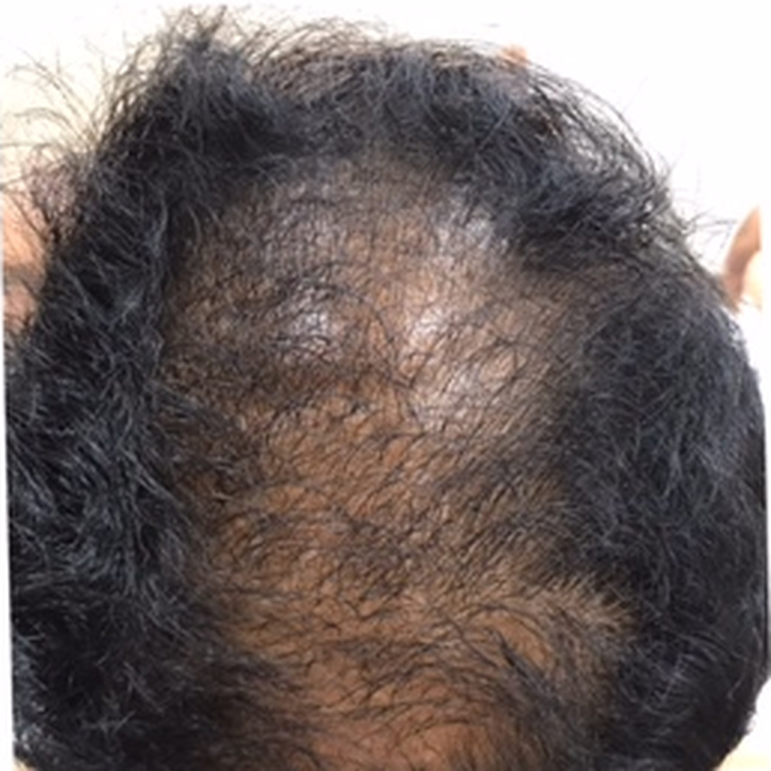 Crown hair thinning before treatment