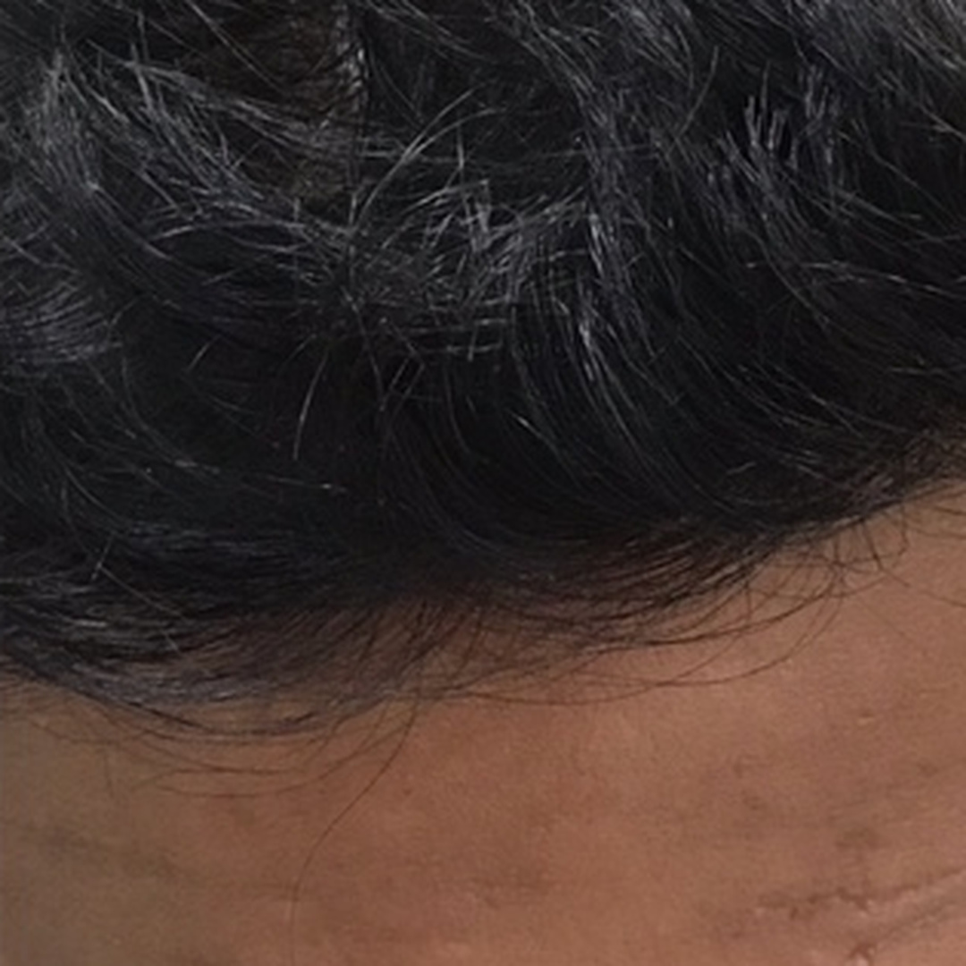 Hairline thinning after treatment