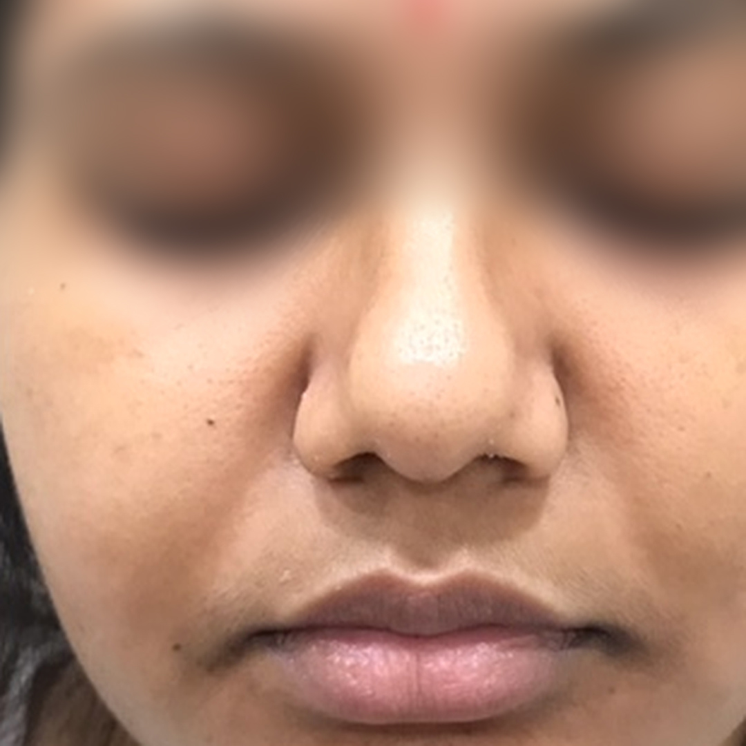 Skin pigmentation after treatment