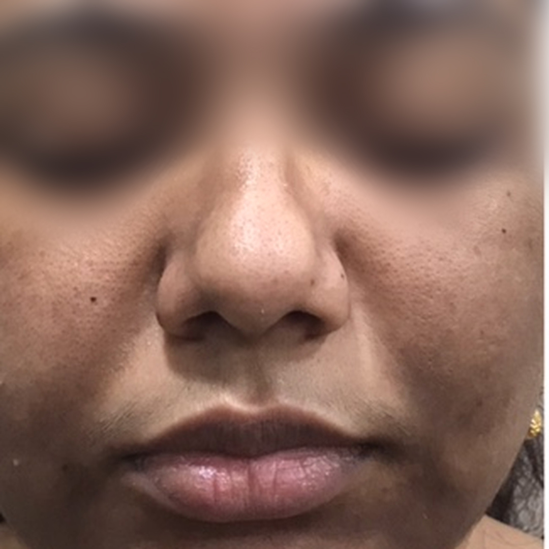 Skin pigmentation before treatment