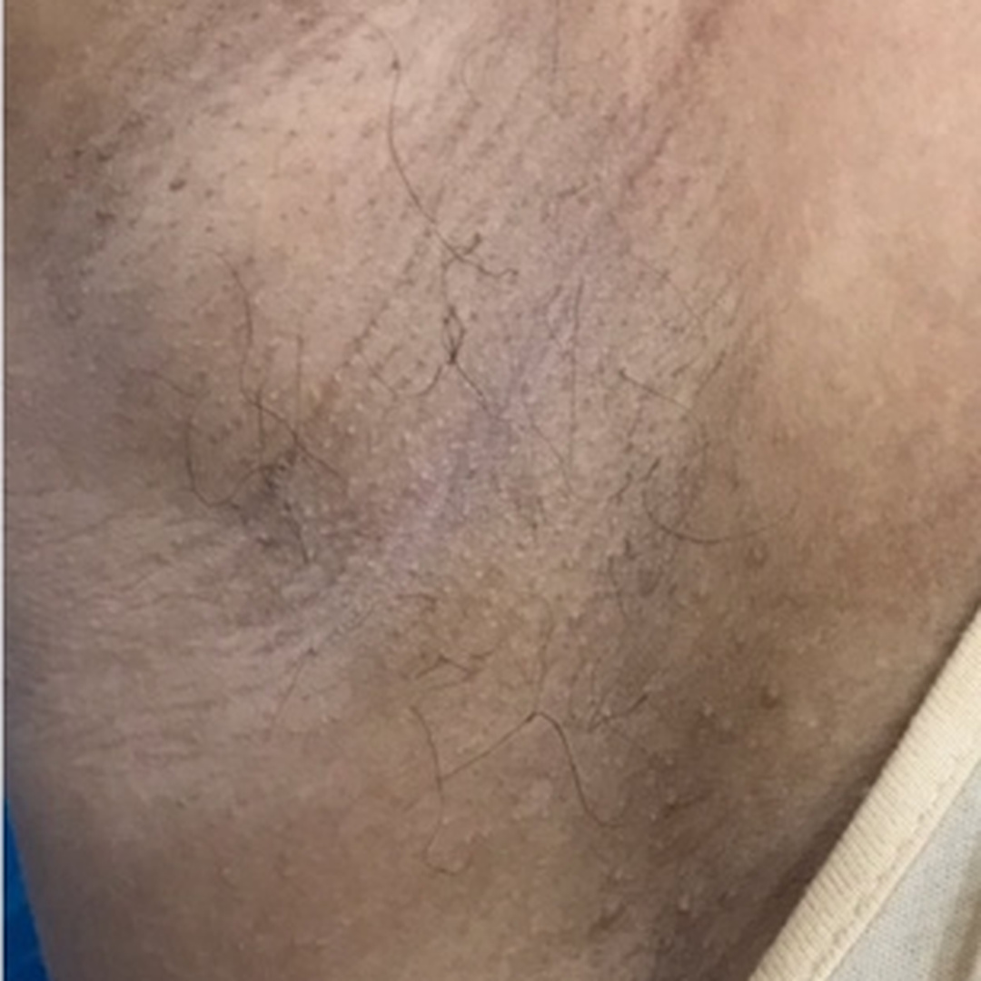 Underarm pigmentation after treatment