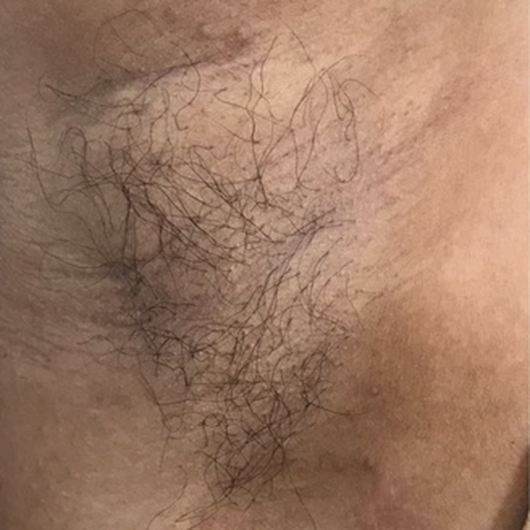 Underarm pigmentation before treatment