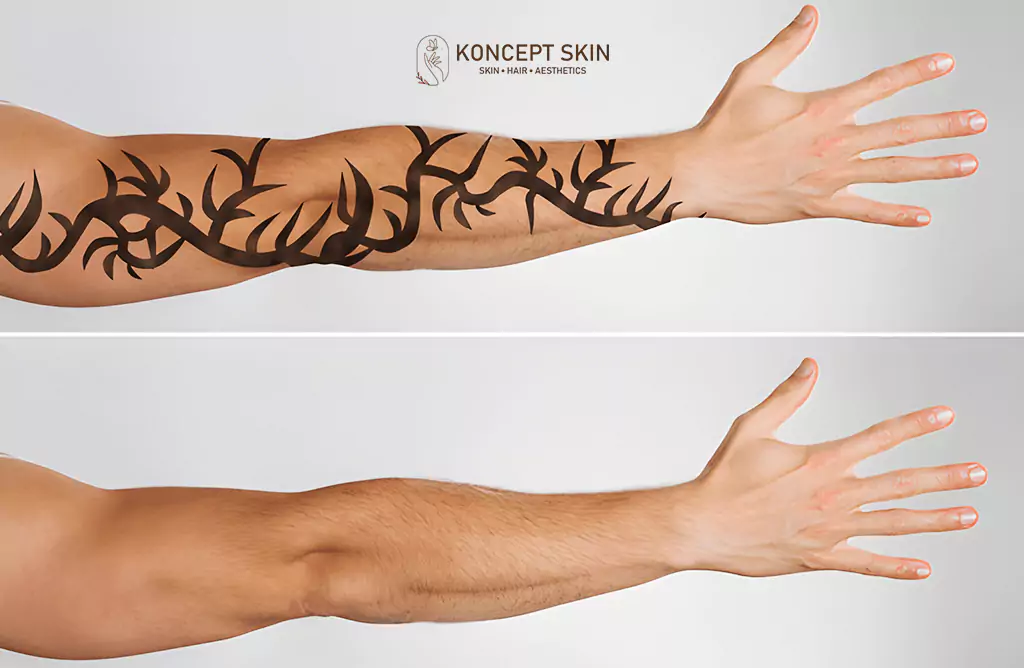 Before and After Laser Tattoo Removal on a Forearm