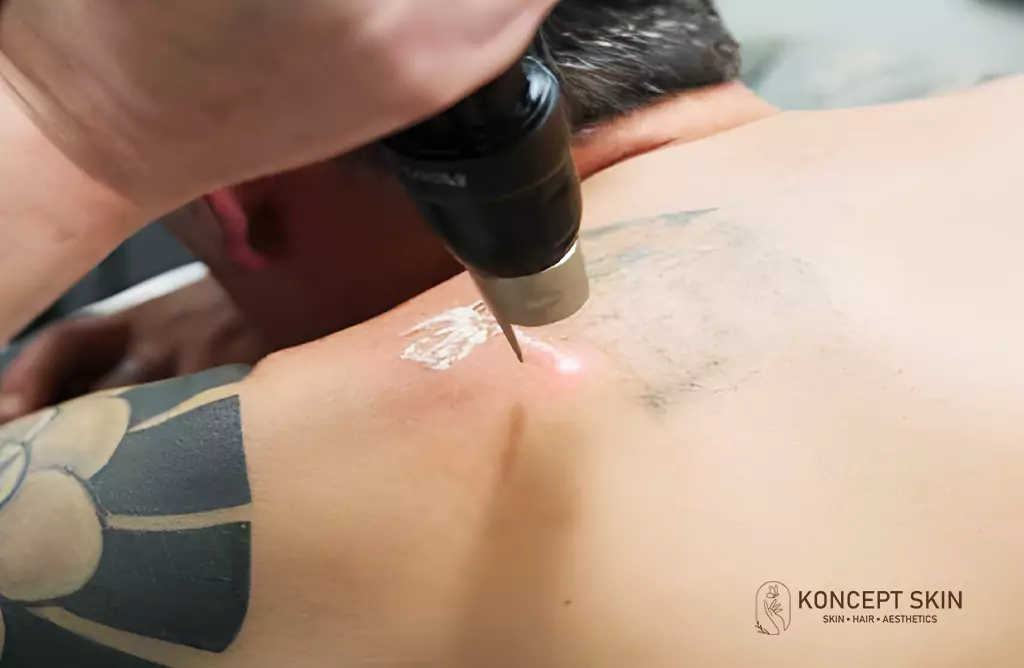 Laser Tattoo Removal in Progress on a Mans Upper Back