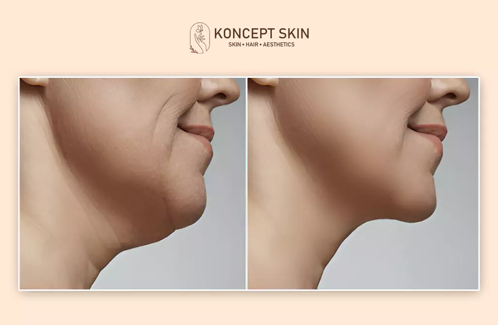 Quick Recovery with Lasting Results After Laser Treatment