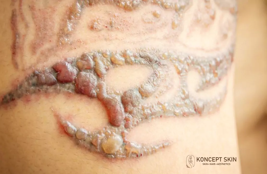 Severe Skin Reaction and Scarring on a Tattooed Area